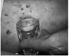 Glass pressed against a skin rash