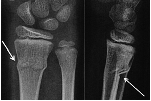 X-ray shows a buckle / torus fracture in bone