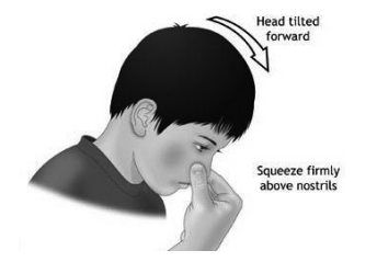 Illustration of a child pinching his nose with thumb and index finger and tilting head forward