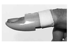 Photograph of index finger in mallet finger splint