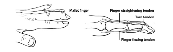 Illustrations of what a mallet finger looks like - the fingertip is bent downwards.